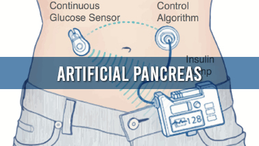 Peers Alley Media: Artificial Pancreas