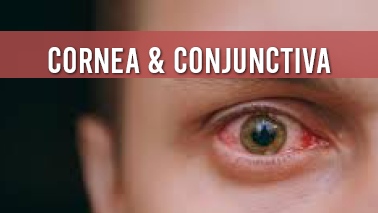 Peers Alley Media: Cornea  Conjunctiva