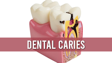 Peers Alley Media: DENTAL   CARIES