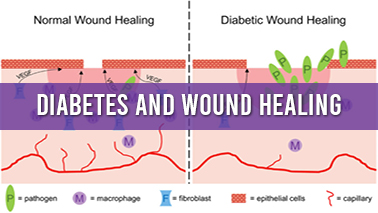 Peers Alley Media: Diabetes and Wound Healing