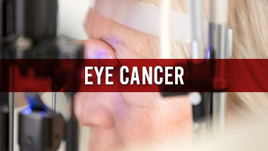 Peers Alley Media: Eye Cancer