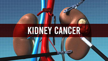 Peers Alley Media: Kidney Cancer