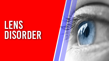 Peers Alley Media: Lens Disorder