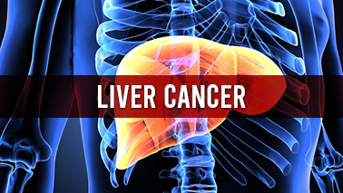 Peers Alley Media: Liver Cancer