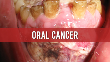 Peers Alley Media: Oral Cancer