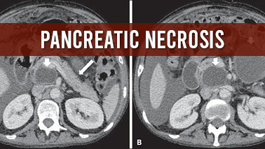 Peers Alley Media: Pancreatic Necrosis