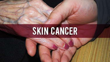 Peers Alley Media: Skin Cancer