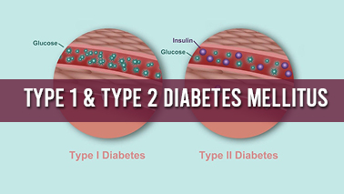 Peers Alley Media: Type 1  Type 2 Diabetes Mellitus