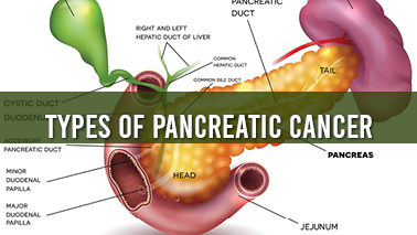 Peers Alley Media: Types of Pancreatic Cancer