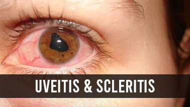 Peers Alley Media: Uveitis  Scleritis