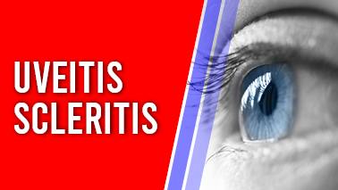 Peers Alley Media: Uveitis Scleritis